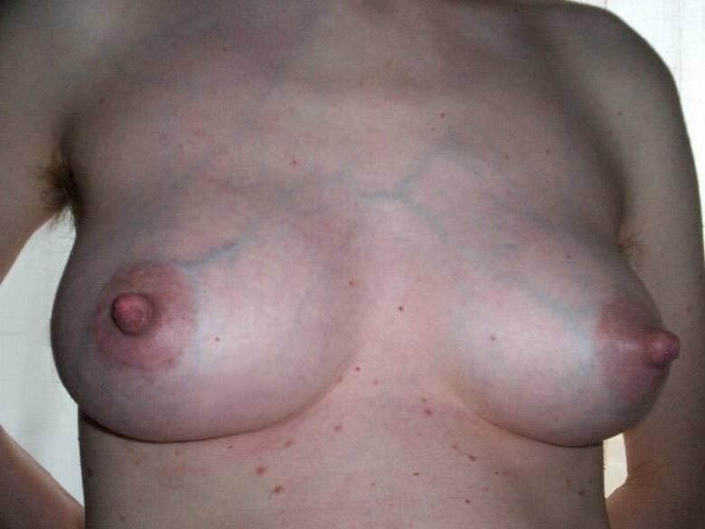 Veins in Tits.