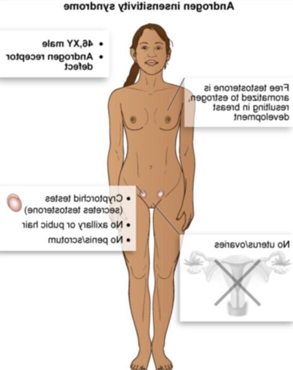 Androgen Insensitivity Syndrome