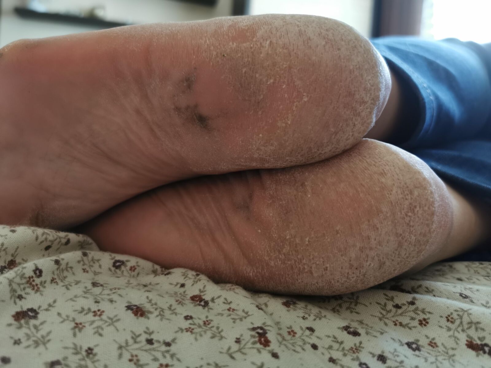 Les pieds de ma mère se sec