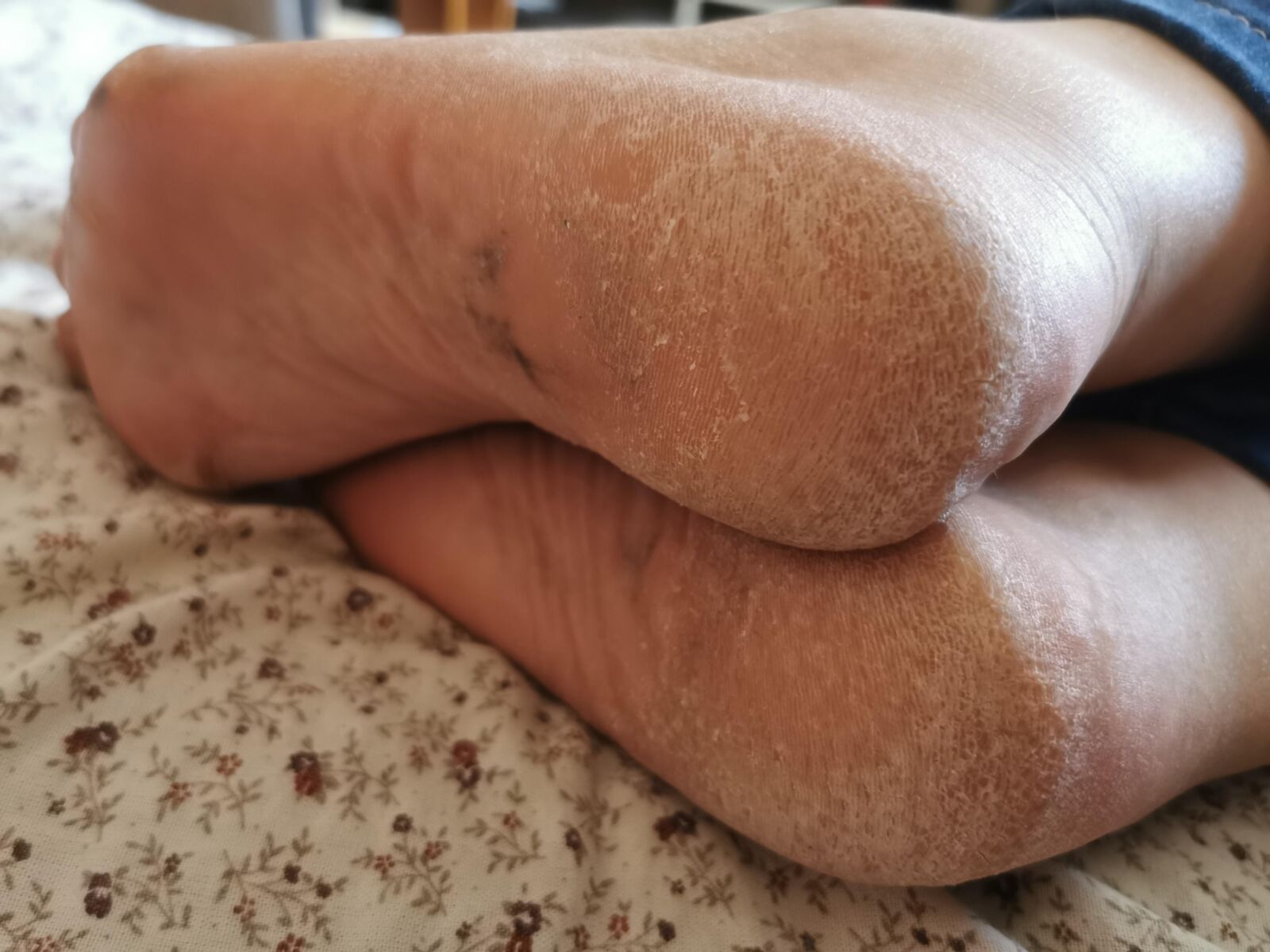 Les pieds de ma mère se sec