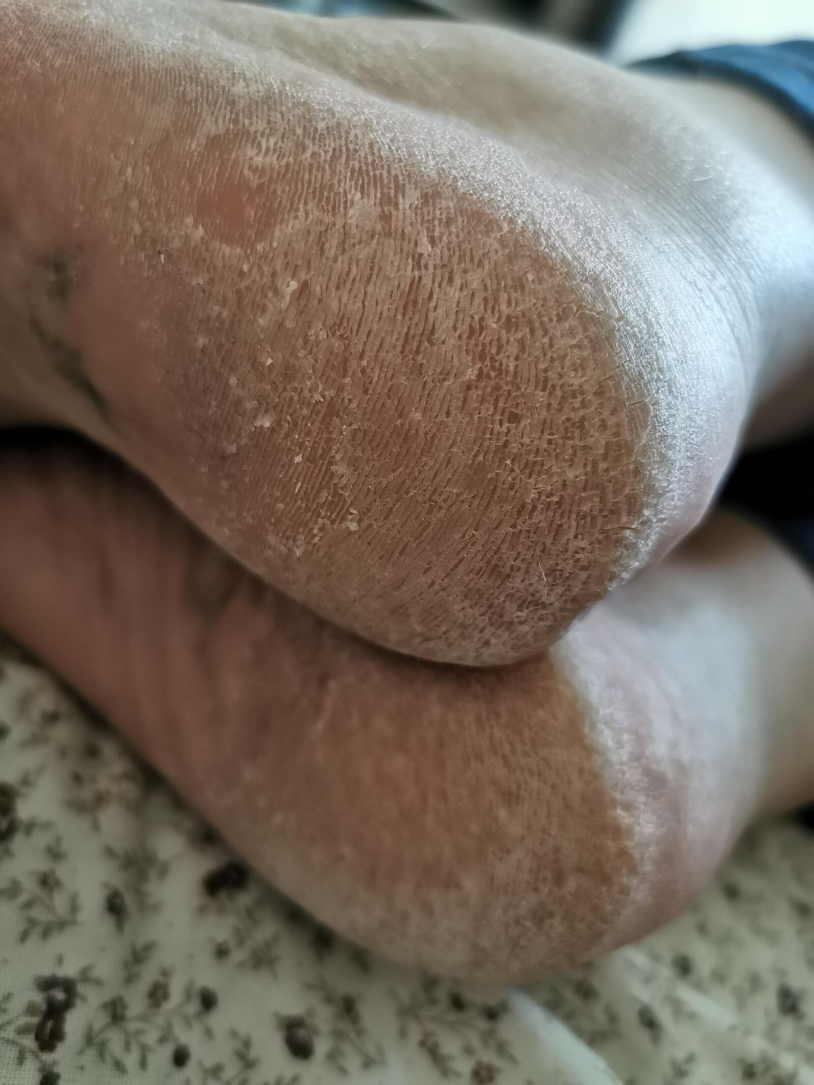 Les pieds de ma mère se sec