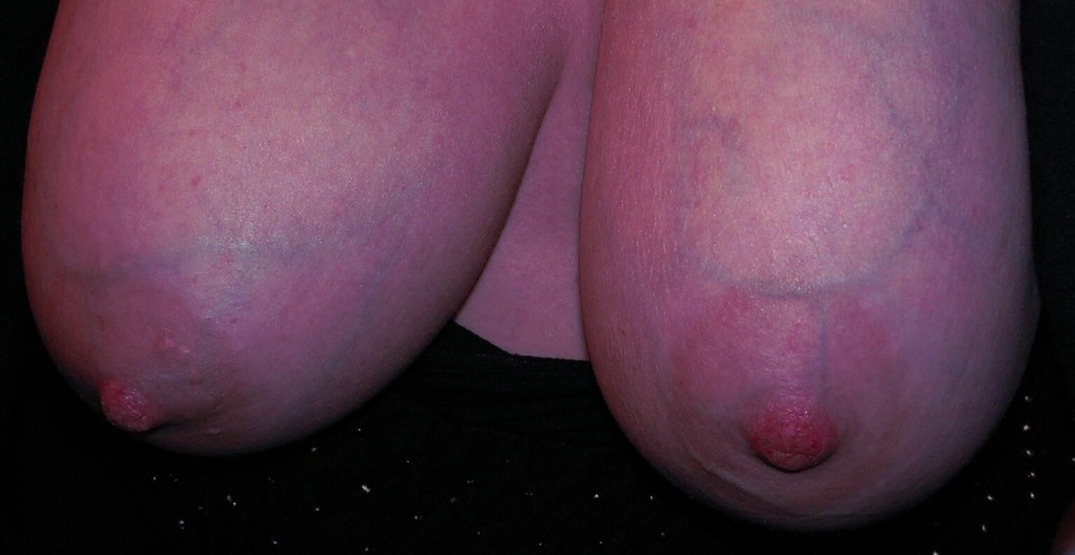 静脈と私のおっぱい。