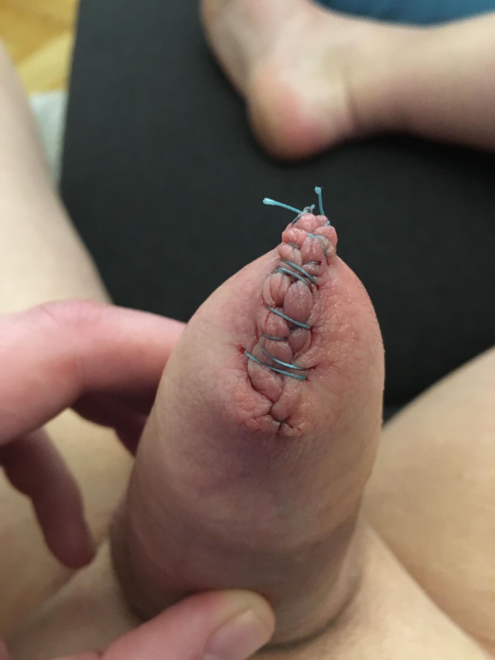Foreskin games (sew foreskin)