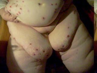 Acne, Sores, Discolored skin