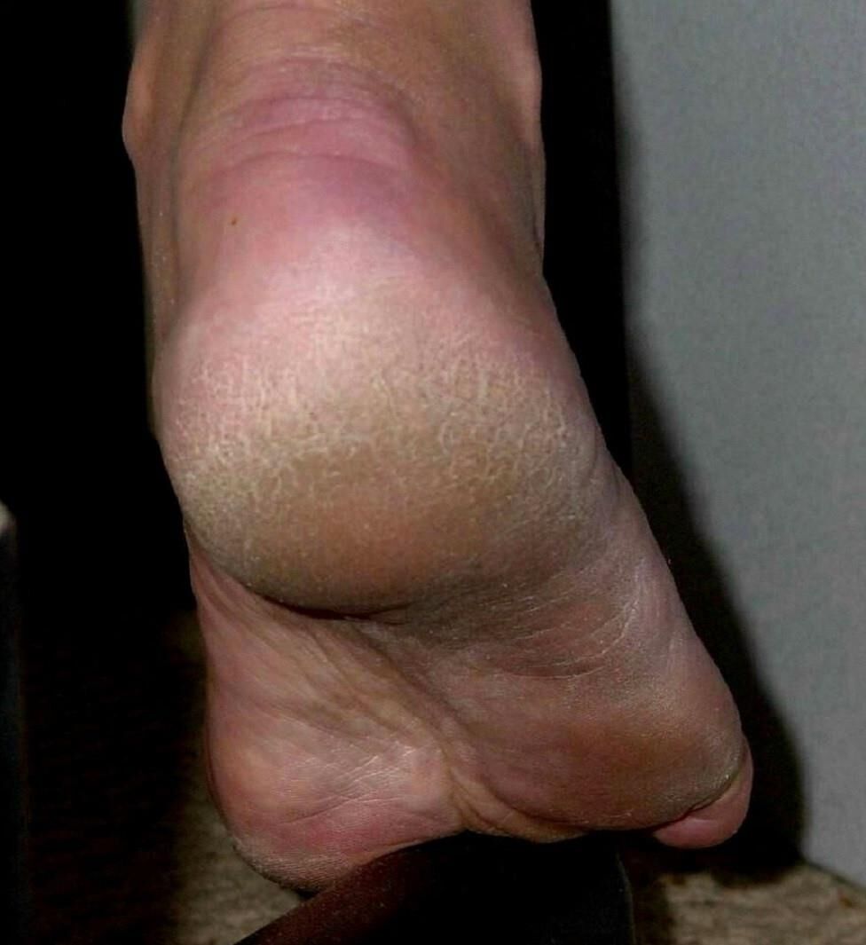 bare foot hard soles and heels close ups cheesy smell
