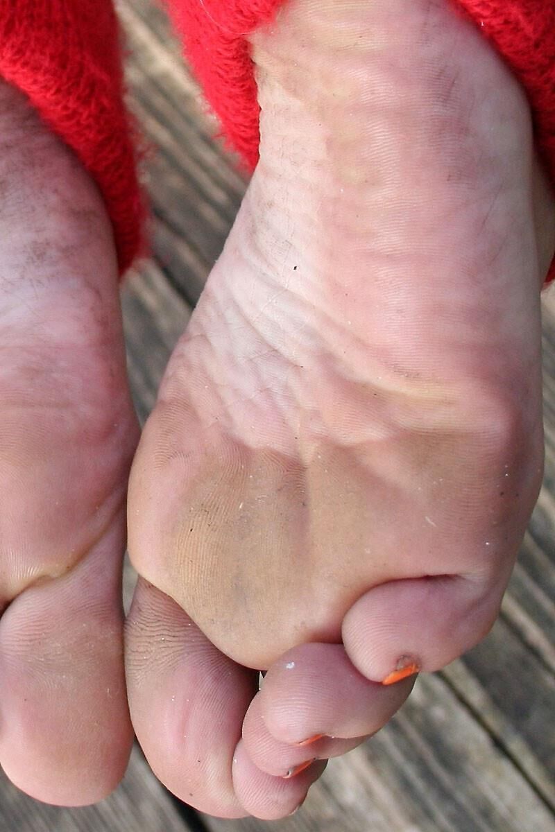 Hot Feet and Soles 