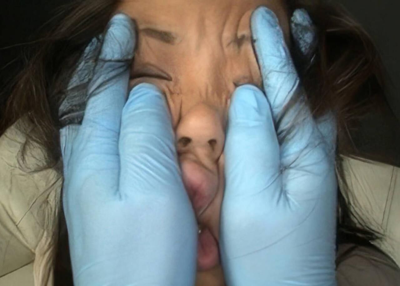 Invaded faces 